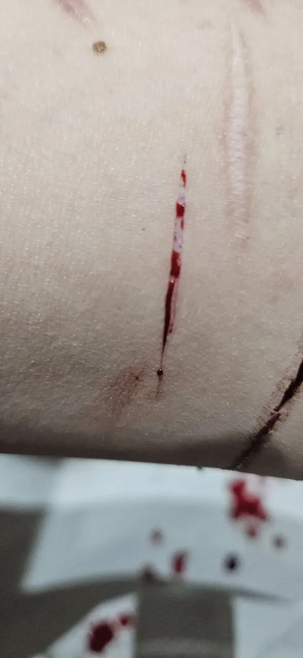 the white part is so pretty before it fills up with blood...>w< sorry for the shallow cuts everyone :c I just got out of the psychward recently and I haven't cut for over a month so I'm still getting myself back into it...